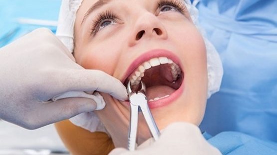 Nhổ răng hàm trên có nguy hiểm không? Có ảnh hưởng gì không?