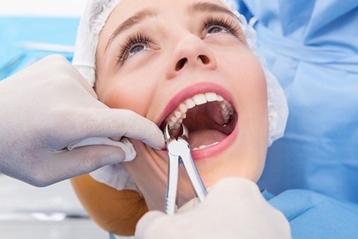 Nhổ răng hàm trên có nguy hiểm không? Có ảnh hưởng gì không?