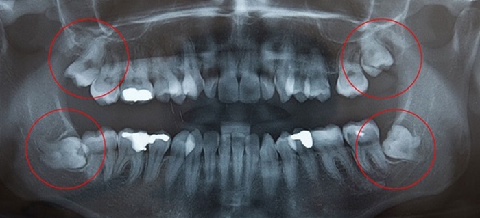 Sâu răng trong cùng khi nào nên nhổ bỏ ? 2