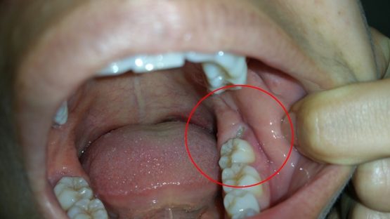 Răng trong cùng – Nên nhổ bỏ hay điều trị để bảo tồn răng?