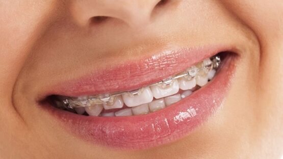 Niềng răng không nhổ răng có được không?