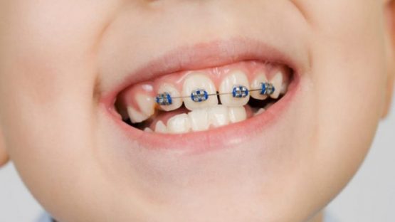 Nắn chỉnh răng cho trẻ em khi nào là phù hợp? Địa chỉ chỉnh răng uy tín