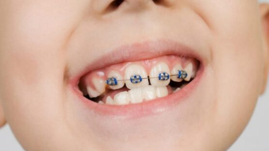 Nắn chỉnh răng cho trẻ em khi nào là phù hợp? Địa chỉ chỉnh răng uy tín