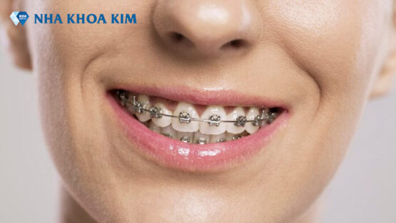 Dịch vụ niềng răng vẩu giá cả phải chăng tại Nha Khoa Kim