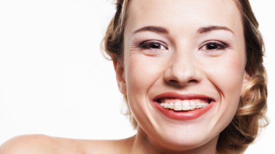 Niềng răng hô mất bao lâu thì có được hàm răng đều đẹp?