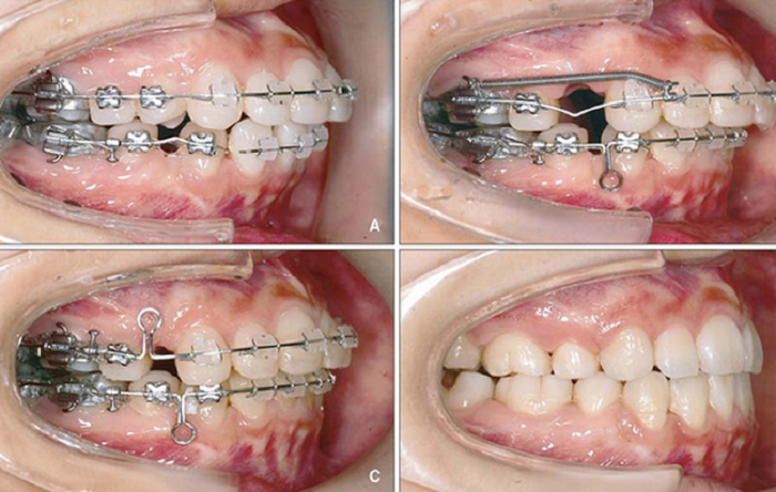 Niềng răng mắc cài tự buộc - Giải pháp chỉnh nha hiệu quả cao 6