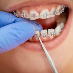 Các loại mắc cài niềng răng hiện nay – Bạn đã biết chưa? Các loại mắc cài niềng răng hiện nay – Bạn đã biết chưa?
