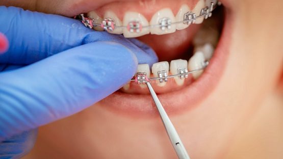 Các loại mắc cài niềng răng hiện nay – Bạn đã biết chưa?
