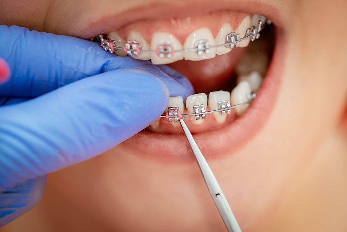 Các loại mắc cài niềng răng hiện nay – Bạn đã biết chưa? 4