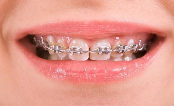 Làm sao dự tính được: Niềng răng thưa giá bao nhiêu tiền khi điều trị?