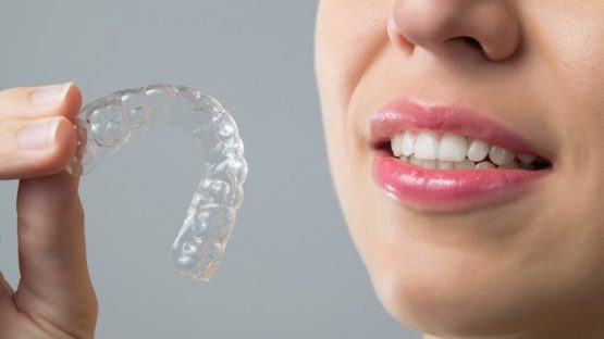 Điều trị bằng phương pháp niềng răng trong suốt giá bao nhiêu tiền?