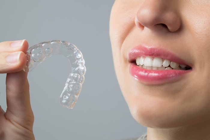 Điều trị bằng phương pháp niềng răng trong suốt giá bao nhiêu? 2