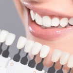 Quy trình tẩy trắng răng – Điều bạn nên nắm rõ khi thực hiện Quy trình tẩy trắng răng – Điều bạn nên nắm rõ khi thực hiện