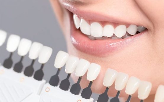 Quy trình tẩy trắng răng – Điều bạn nên nắm rõ khi thực hiện