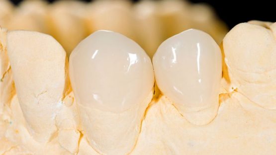 Quy trình trồng răng sứ chuẩn xác, an toàn & không đau