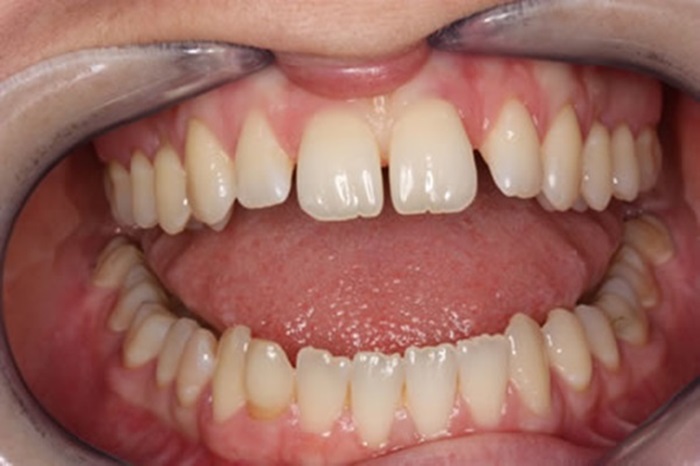 Hàn trám răng thưa se khít khoảng trống cho hàm răng đều 1
