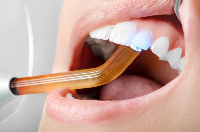 Trám răng thẩm mỹ ở đâu tốt nhất? Tham khảo ý kiến chuyên gia
