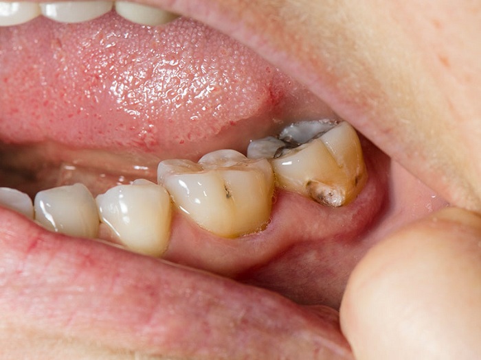 Răng sâu do tiếp xúc với thức ăn, chất đường - Nha Khoa Kim