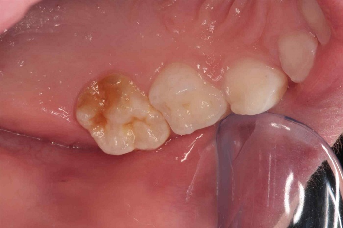 Răng hàm mới chớm sâu, chưa hình thành lỗ đen trên răng - Nha Khoa KIM