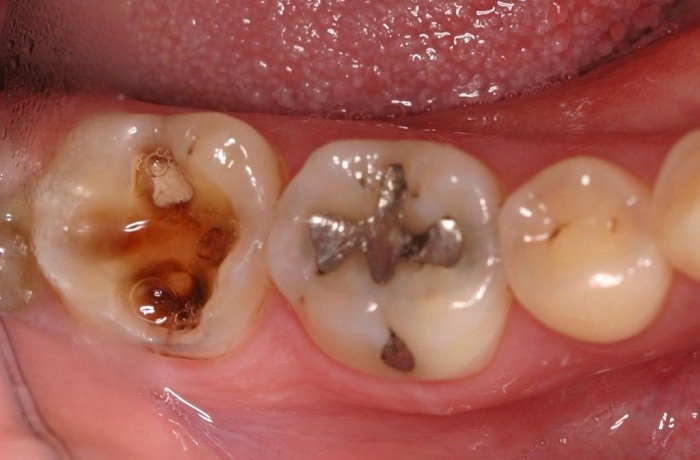 Tình trạng răng sâu đã lan tới tủy - Nha Khoa KIM