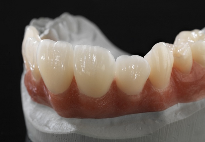răng sứ ceramill 1
