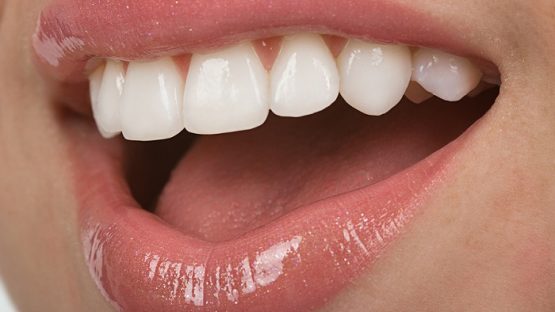 Răng sứ Ceramill – Dòng răng sứ toàn sứ cao cấp được ưa chuộng