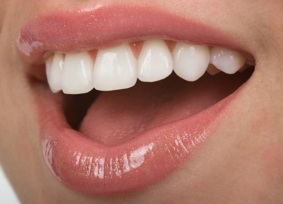 Răng sứ Ceramill – Dòng răng sứ toàn sứ cao cấp được ưa chuộng