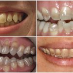 Tẩy răng bị nhiễm kháng sinh có được không? Cách nào hiệu quả? Tẩy răng bị nhiễm kháng sinh có được không? Cách nào hiệu quả?