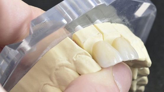 Bọc răng sứ Titan – Phục hình răng bền chắc, tiết kiệm