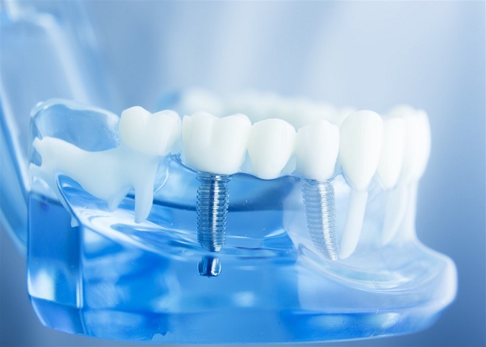 Cắm Implant thay thế răng đã mất bền chắc suốt đời