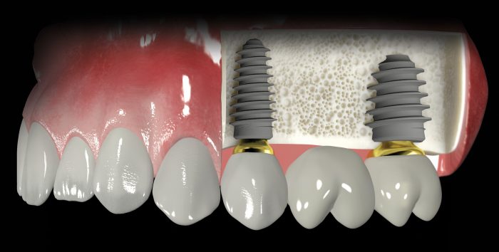 Trồng răng implant của Đức – Ăn nhai thoải mái, bền chắc suốt đời 2