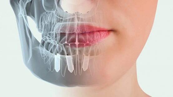 Trồng răng Implant tại Hà Nội – Địa chỉ uy tín và tốt nhất hiện nay