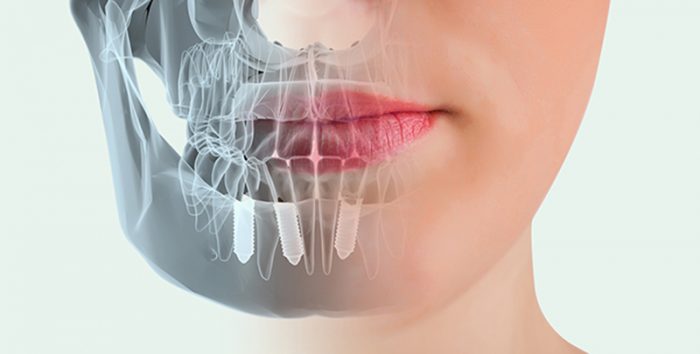 Địa chỉ trồng răng implant tại Hà Nội – Uy tín và chất lượng cao 1