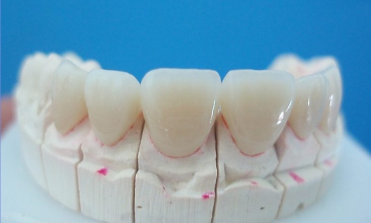 Răng sứ Ceramill giá bao nhiêu?