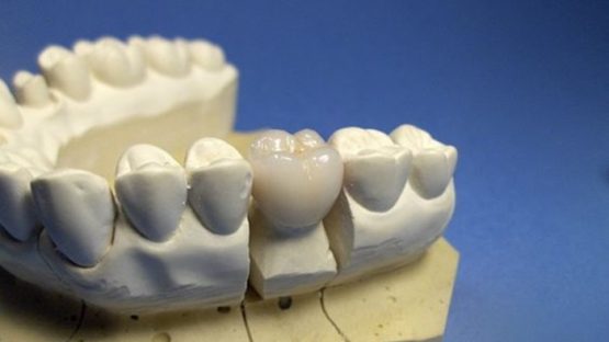 Trồng răng phục hình và những thông tin bổ ích cần biết