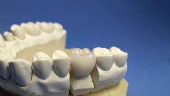 Trồng răng phục hình và những thông tin bổ ích cần biết