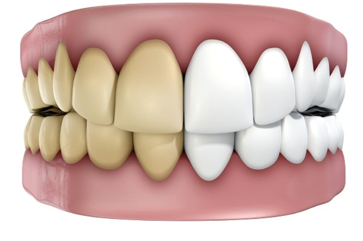 Chân răng bị đen – Nguyên nhân do đâu, làm sao loại bỏ vết đen hiệu quả? Chân răng bị đen – Nguyên nhân do đâu, làm sao loại bỏ vết đen hiệu quả?