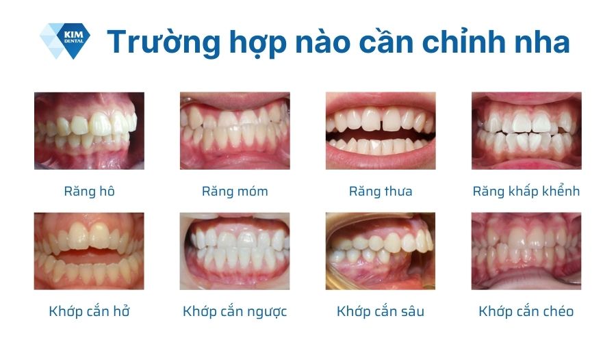 Các trường hợp cần chỉnh nha