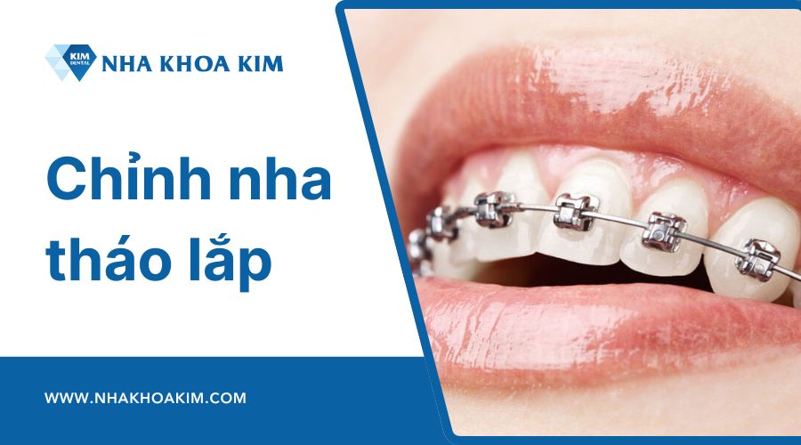 Chỉnh nha tháo lắp