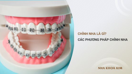 Chỉnh nha là gì? Các phương pháp chỉnh nha hiệu quả