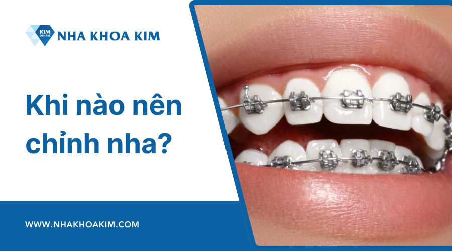 Khi nào nên chỉnh nha?