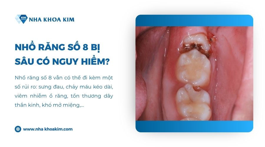 Nhổ răng số 8 bị sâu có nguy hiểm không?