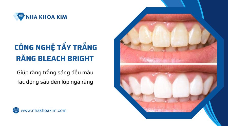 Tẩy trắng răng bị nhiễm fluor