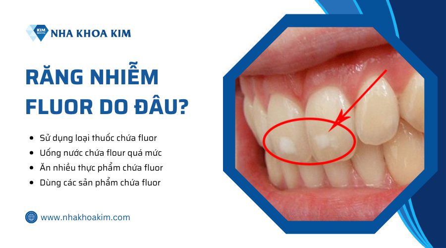Nguyên nhân răng nhiễm fluor