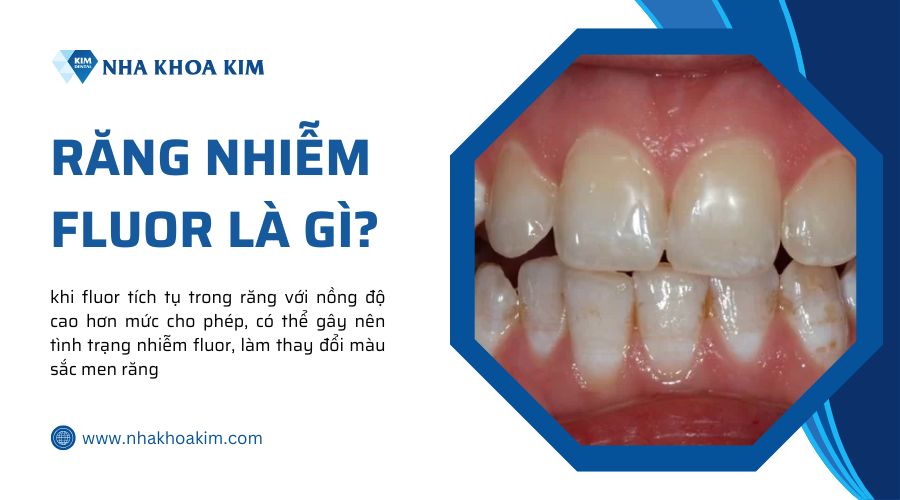 răng nhiễm fluor là gì