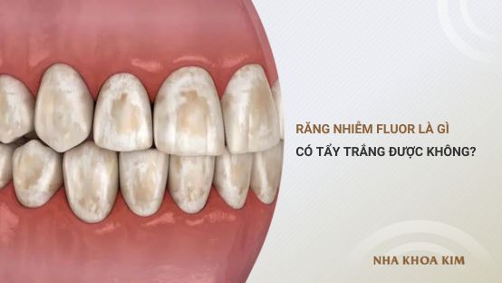 Răng nhiễm fluor là gì? Có tẩy trắng được không?