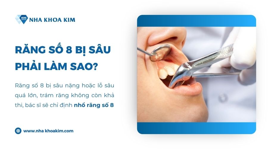 Răng số 8 bị sâu phải làm sao?