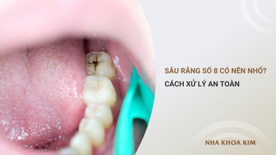 Sâu răng số 8: Có nên nhổ hay không? Cách xử lý an toàn