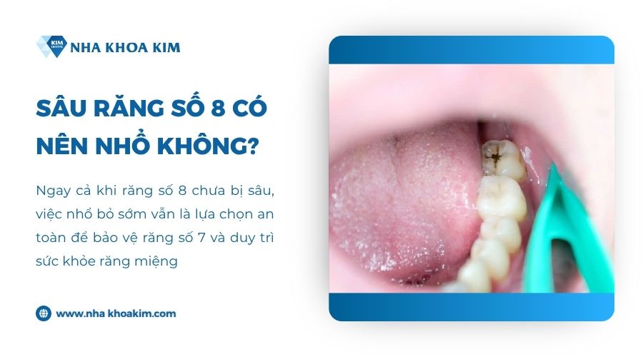 Sâu răng số 8 có nên nhổ không?