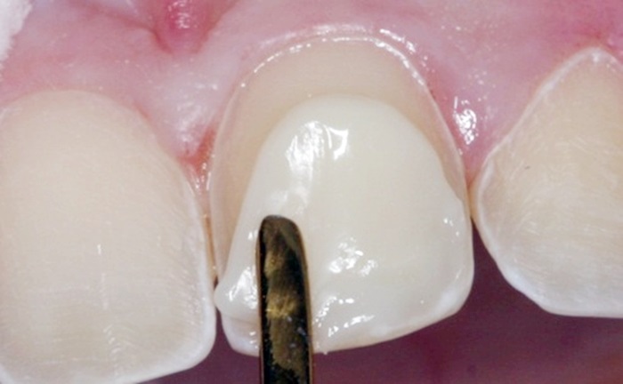 Trám răng composite - Giải pháp tái tạo răng Nhanh & An toàn 2
